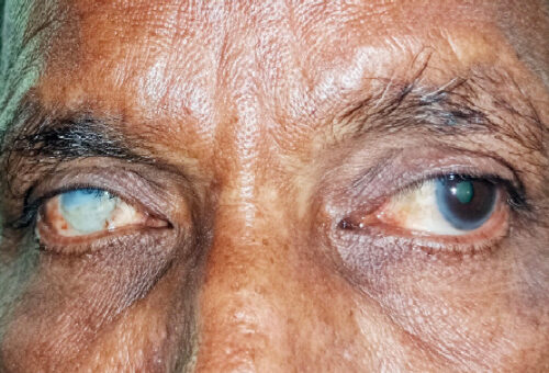 Nigeria’s Search For Sustainable Eye-Care Funding